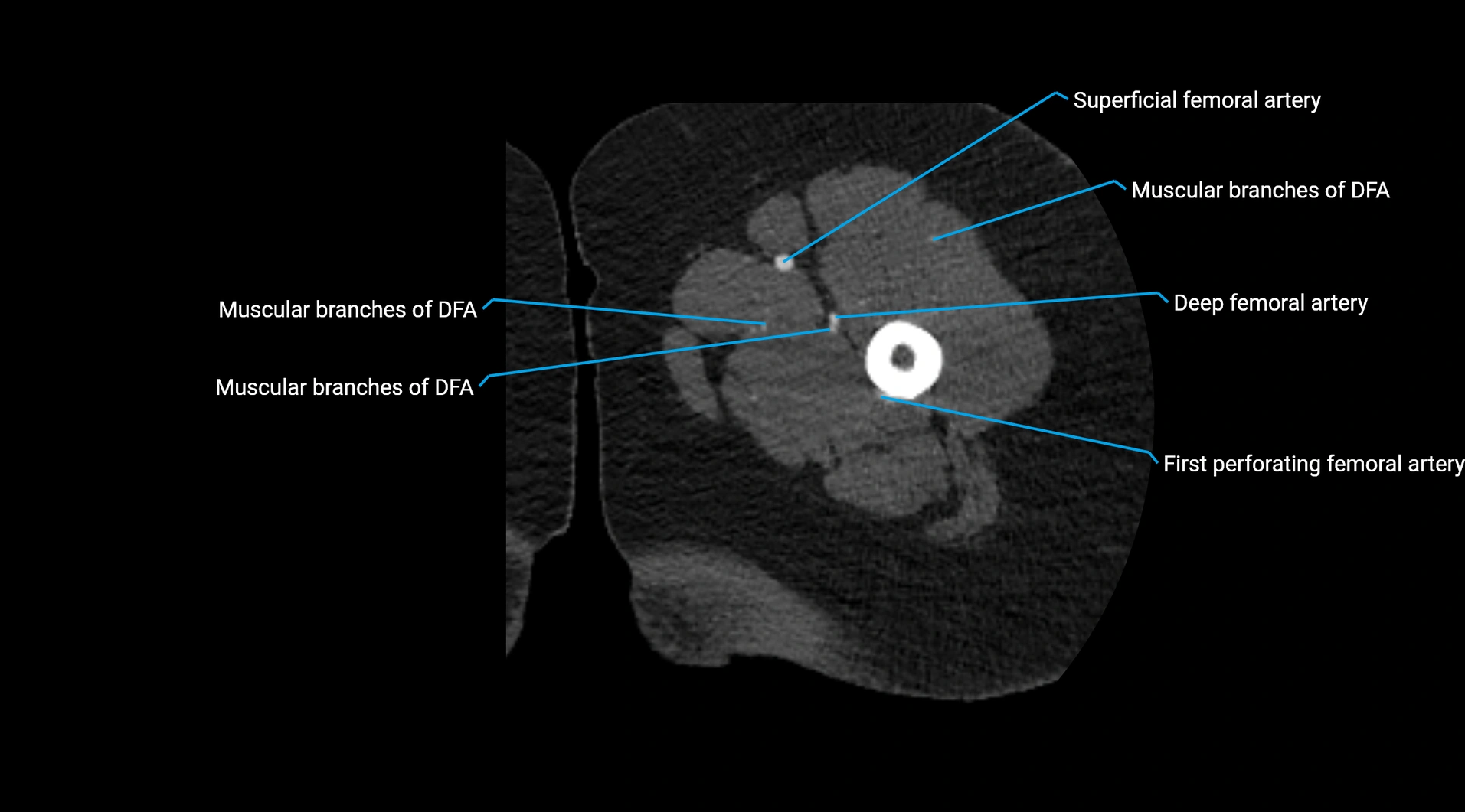 CTA lower limb cross sectional anatomy labelled image _100.webp